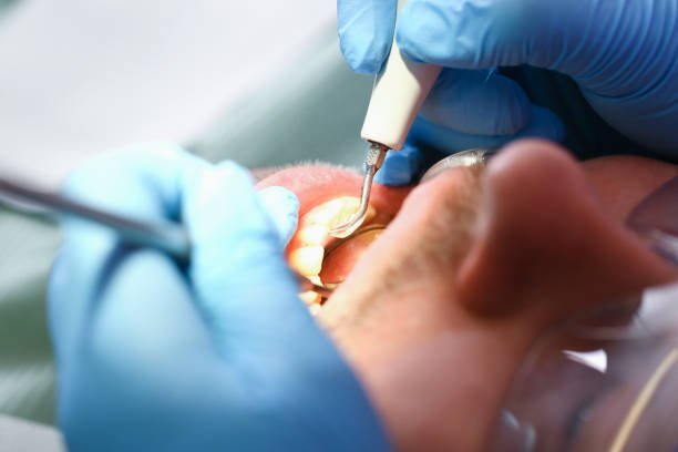 Best Emergency Tooth Extraction in Severn, MD