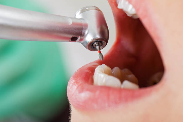 Best Emergency Dental Care for Broken or Chipped Teeth in Severn, MD